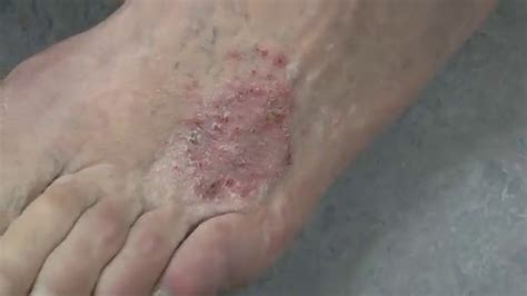 Fungal infection on a patient's legs - YouTube