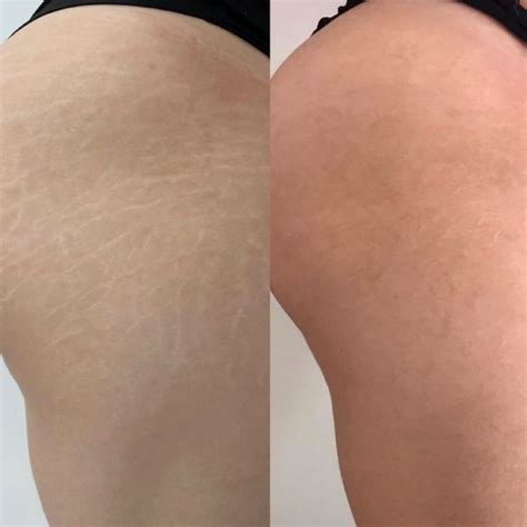 Stretch Mark Laser Removal: Before And After Results [Real Cases] | Heliotherapy Research Institute