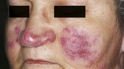 Malar Rash: Causes, Symptoms, Treatment, Picture, and More