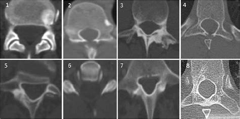 Radiofrequency ablation of spinal osteoid osteoma: a prospective study in: Journal of ...