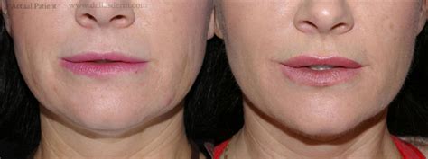 Liquid Face Lift with Restylane/Juvederm/Radiesse | Sculptra | Botox or ...