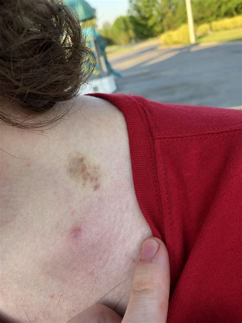 is this a hickey on my boyfriends neck? : r/relationship_advice