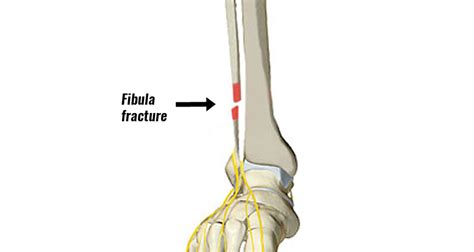 Fibula Fracture - Types, Symptoms, Causes and Rehabilitation