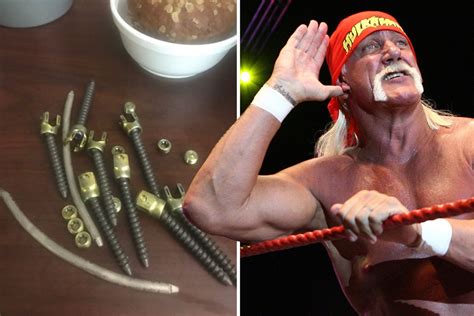 WWE legend Hulk Hogan shares picture of huge screws he had in his back after undergoing surgery ...