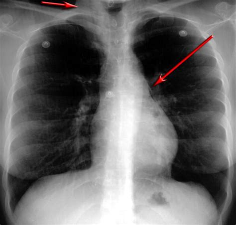 PICTURES AND IMAGES : X-RAYS ASTHMA | Radiography, Asthma, Disorders