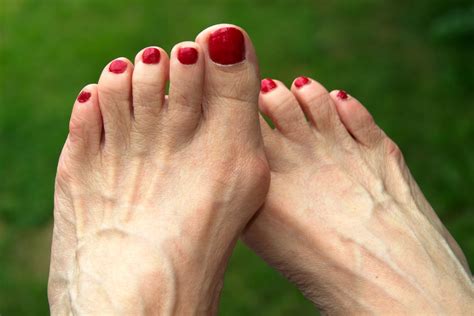 What Is a Bunion? - Celebration Foot & Ankle Institute