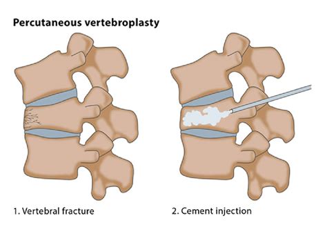 Sydney Internventional Radiology | Sydney | Vertebroplasty