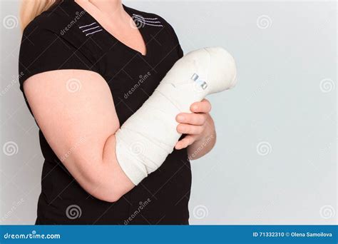 Young Female with Broken Hand in Cast Stock Photo - Image of anatomy, invalid: 71332310