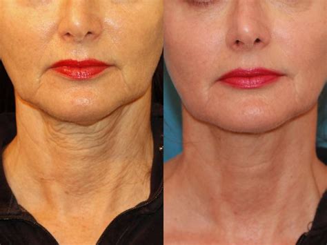 Sculptra® Before and After Photo Gallery | Atlanta, Georgia | Buckhead Facial Plastic Surgery