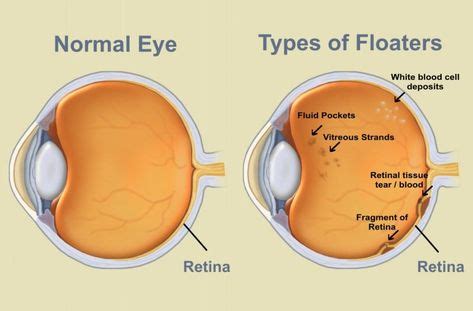 Floaters are small pieces of “debris” that float within the jelly of the eye called the vitreous ...