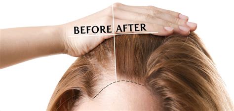 Hair Transplant For Women: An Overview - hanoverorient