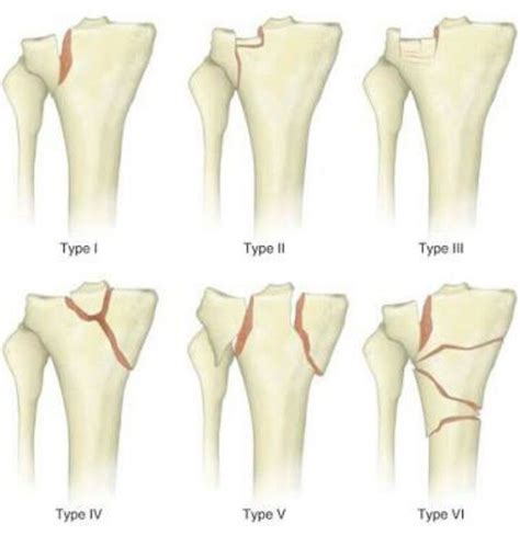 SCHATZKER CLASSIFICATION FOR TIBIA PLATE FRACTURES | Tibial plateau ...