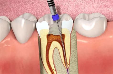 Root Canal Recovery Time | Root canal treatment, Root canal, Dentist