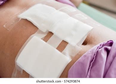 106 Hysterectomy scar Images, Stock Photos & Vectors | Shutterstock