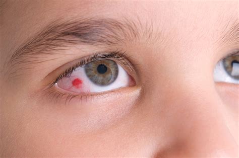 Common Causes of Pink Eye | Optometrist in Pembroke Pines, FL | The Family Eye Site The Family ...