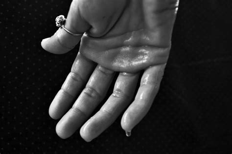 What Causes Clammy Hands And How To Deal With It - The Nfrw