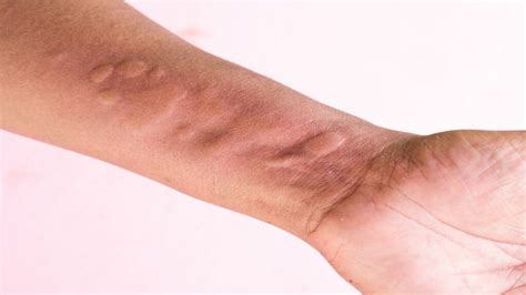 Doctors Explain What Happens to Your Body if You Develop Hives