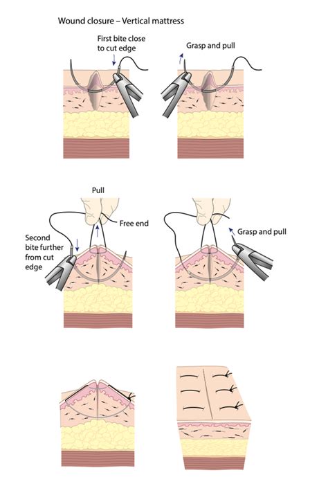 Suture Techniques - RCEMLearning India