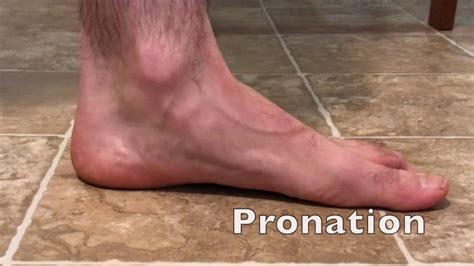 What Causes Pronation Of Foot