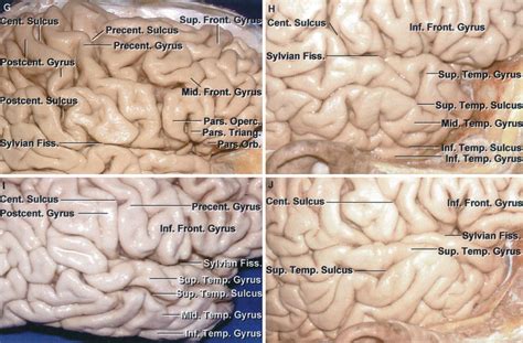 Identification of the Pre- and Postcentral Gyri and Variations in the Frontal and Temporal Lobe ...