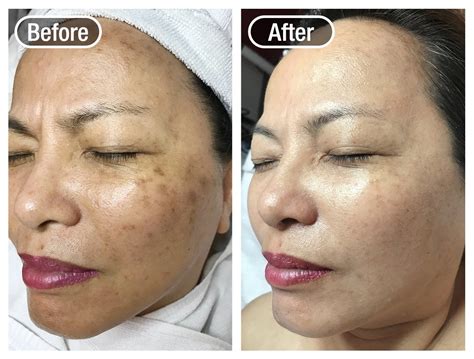 Facial Treatment in SG | Shakura Pigmentation Specialist