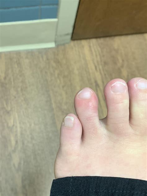 Unexplained “toe sores”/Raynaud’s : r/Raynauds