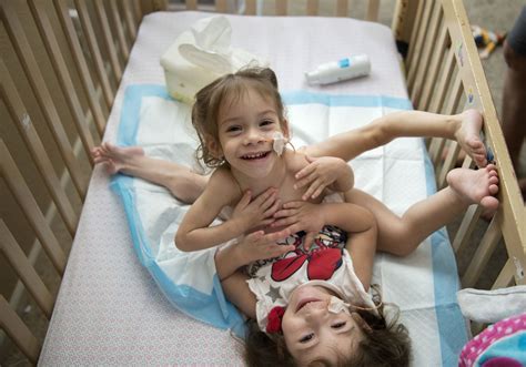 Conjoined twins prepare for separation surgery at Stanford hospital ...