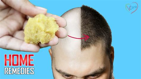 10 POWERFUL HOME REMEDIES FOR HAIR LOSS & HAIR THINNING | Anaaya Foods