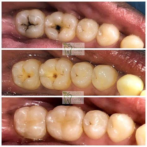 TOOTH CAVITY or TOOTH DECAY is the most common ora