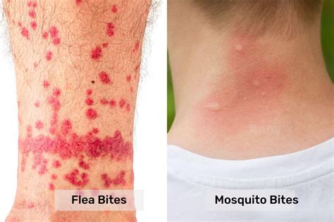 flea bites vs mosquito bites - Pest Control Gurus