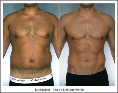 New York Male Liposuction Before and After Photo Gallery by Dr. John E ...