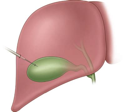 Percutaneous Cholecystostomy Drain Care - Best Drain Photos Primagem.Org