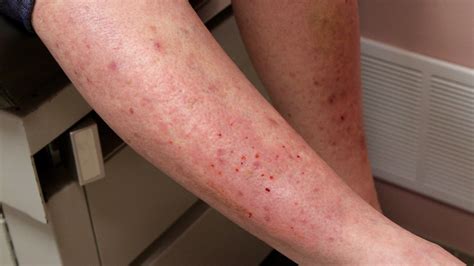 Blåsdermatoser: Dermatitis herpetiformis | Praktisk Medicin