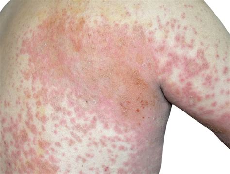 Hiv Symptoms Rash - Infoupdate.org