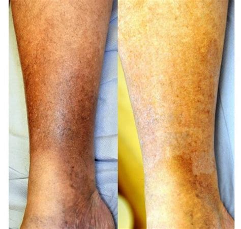 Haemosiderin - Brown Stains Treatment – The Whiteley Clinic