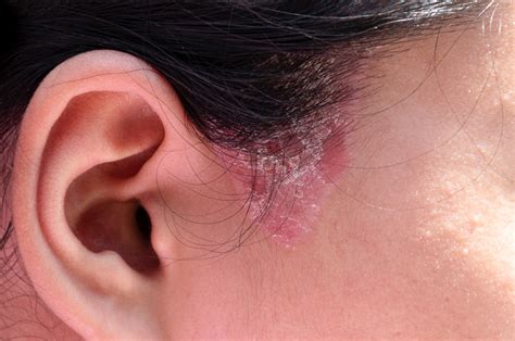 Scalp Psoriasis: Causes, Symptoms and Treatment | Watsons Singapore