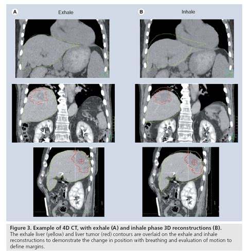 Advances in imaging for liver cancer radiation therapy