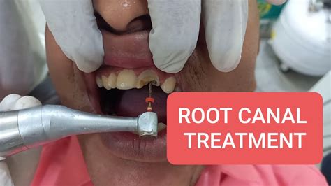 Root Canal procedure Treatment - YouTube