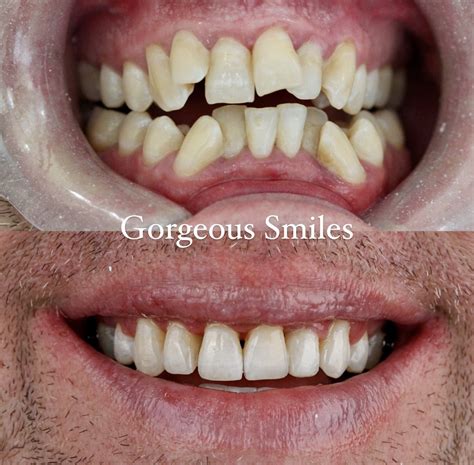 Braces Before And After Pictures - Gorgeous Smiles