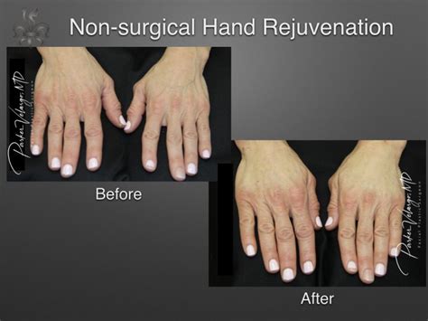 Hand Rejuvenation Archives - New Orleans Premier Center for Aesthetics and Plastic Surgery