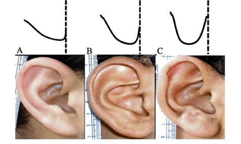 Unattached Earlobes