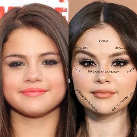 Selena gomez before and after plastic surgery – Artofit