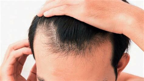 Uneven Hairlines - Why It Happens and How to Fix It