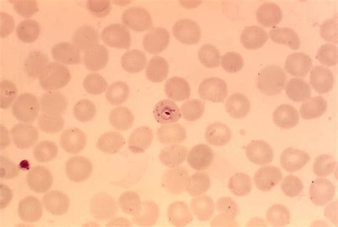 Kostenlose Bild: Plasmodium falciparum, Ringe, zart, Zytoplasma, klein, Chromatin, Punkte