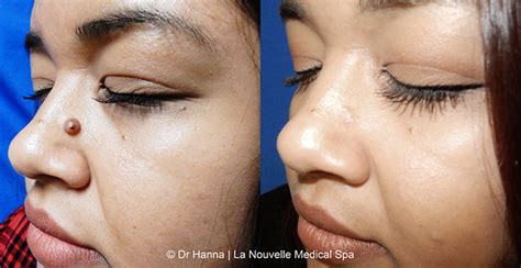 Mole Removal Before and After Photos by Dr. Hanna | Ventura