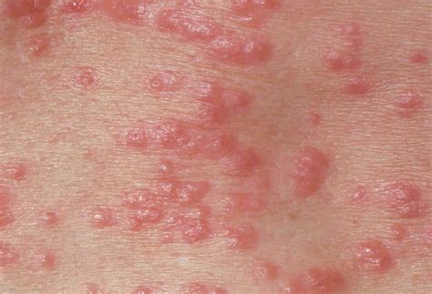 13 Pictures of Common Skin Rashes