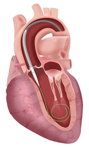 Transcatheter Aortic Valve Replacement (TAVR) - healingvalves