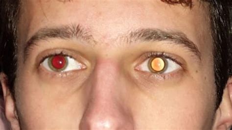 Red Eye Effect: What Do They Indicate? | What Causes Red Eye In Photos