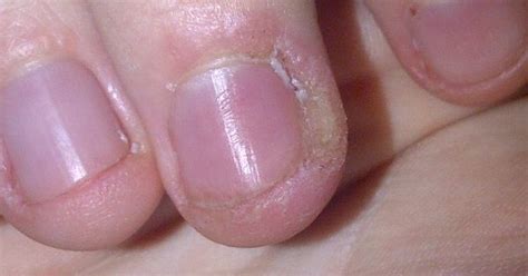 8 Home Remedies for Ingrown Fingernail Along with Causes and Symptoms | Home, Toe and Nails