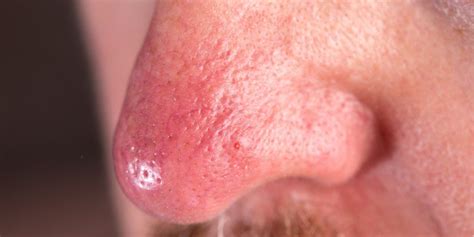 Drinker’s Nose: Is Drinker’s Nose a Real Condition? Blackberry Center